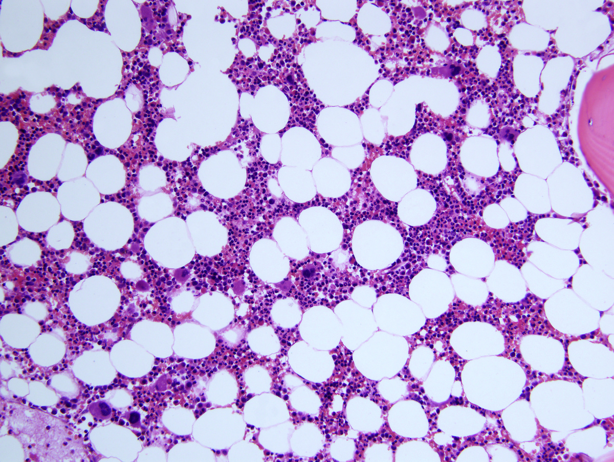 Hypocellular bone marrow with decreased trilineage hematopoiesis and scattered dysplastic megakaryocytes.